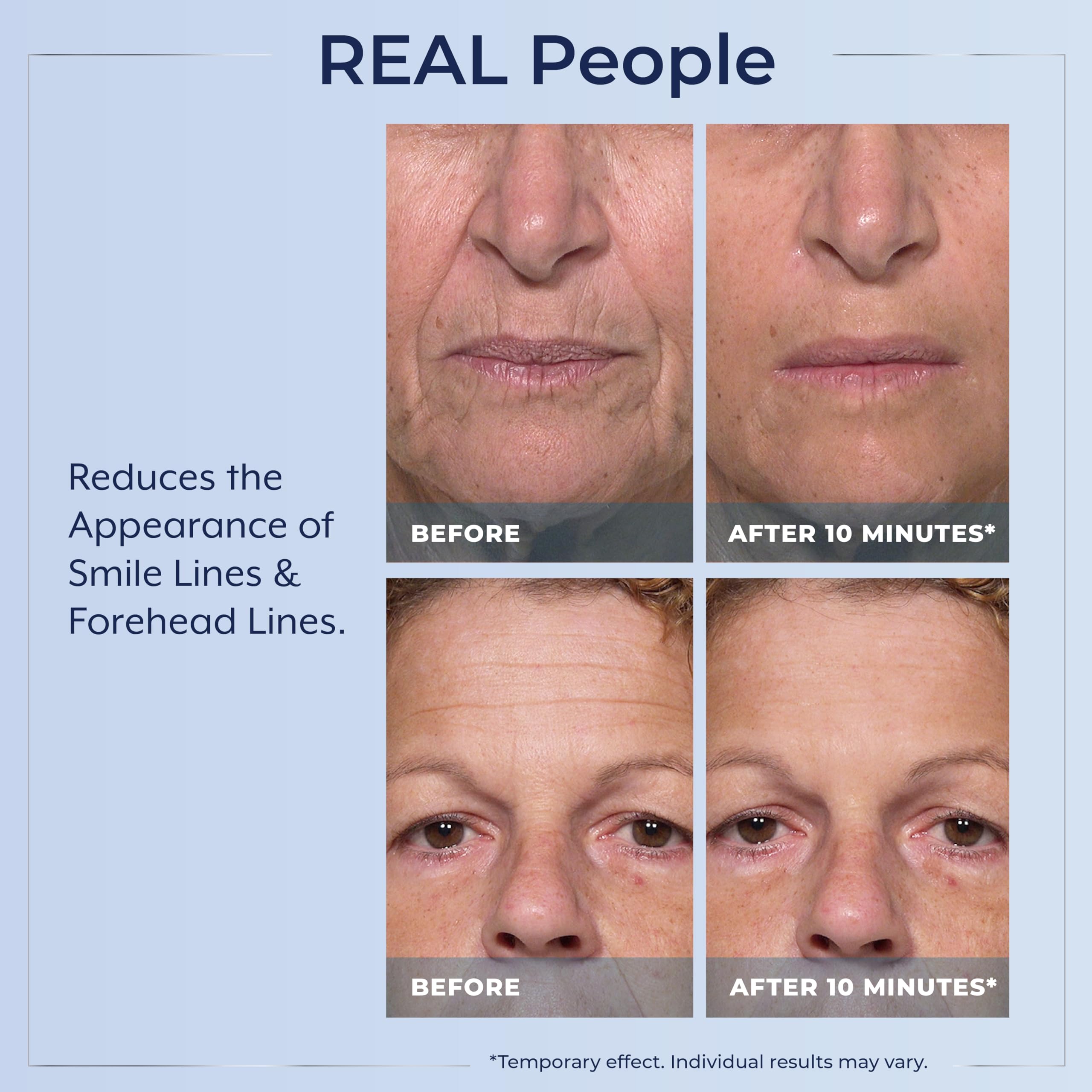 Plexaderm levantamiento instantáneo facial para un aspecto más joven.