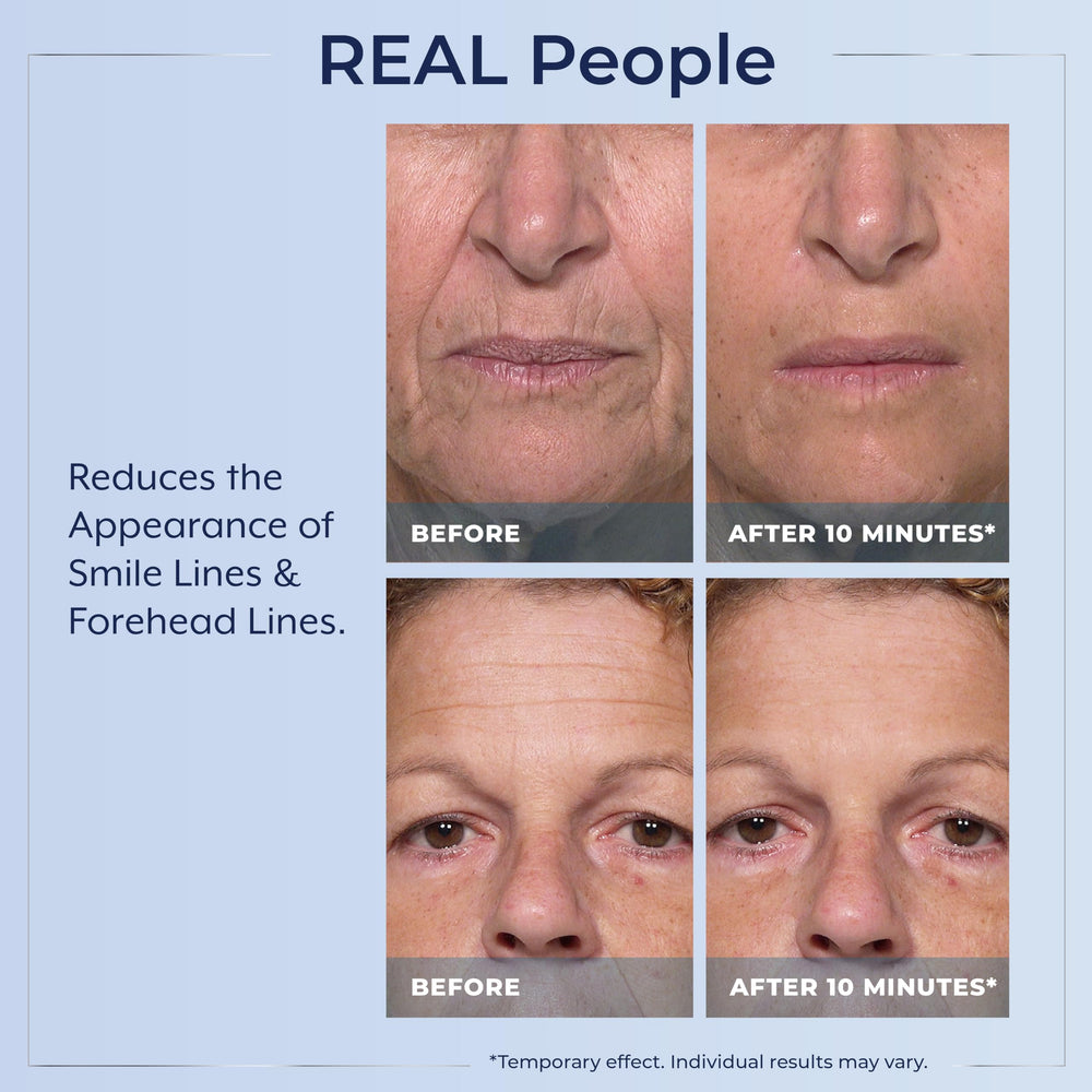 Plexaderm levantamiento instantáneo facial para un aspecto más joven.