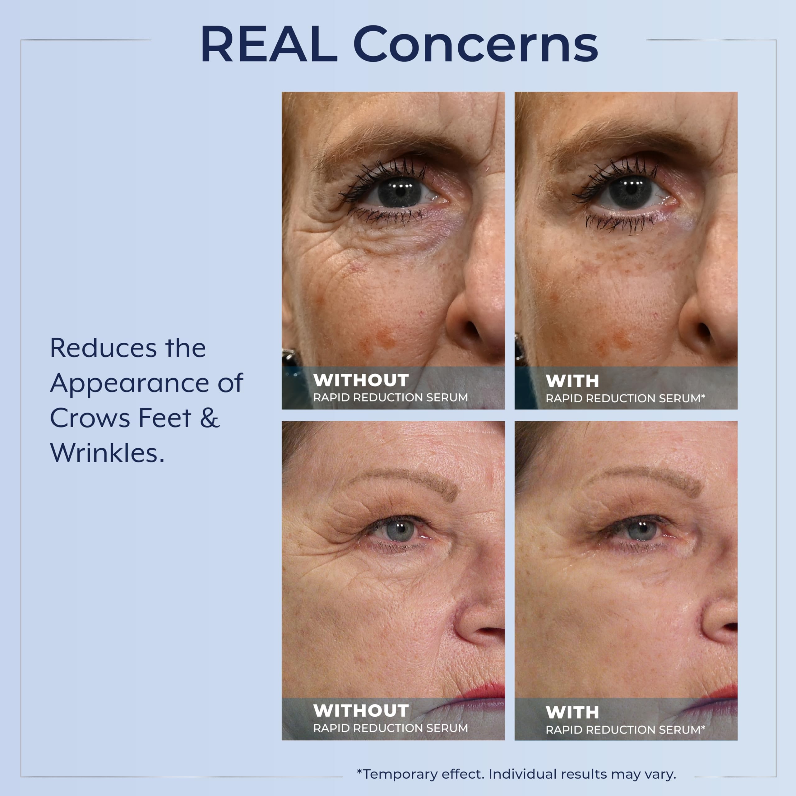 Plexaderm enfoque en la zona de ojos para reducir bolsas y arrugas.