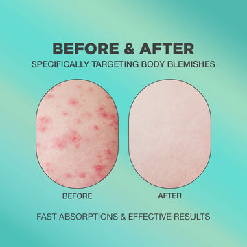 PROOT Crema acne nalgas, textura ligera, hidrata sin dejar grasa.