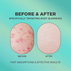 PROOT Crema acne nalgas, textura ligera, hidrata sin dejar grasa.