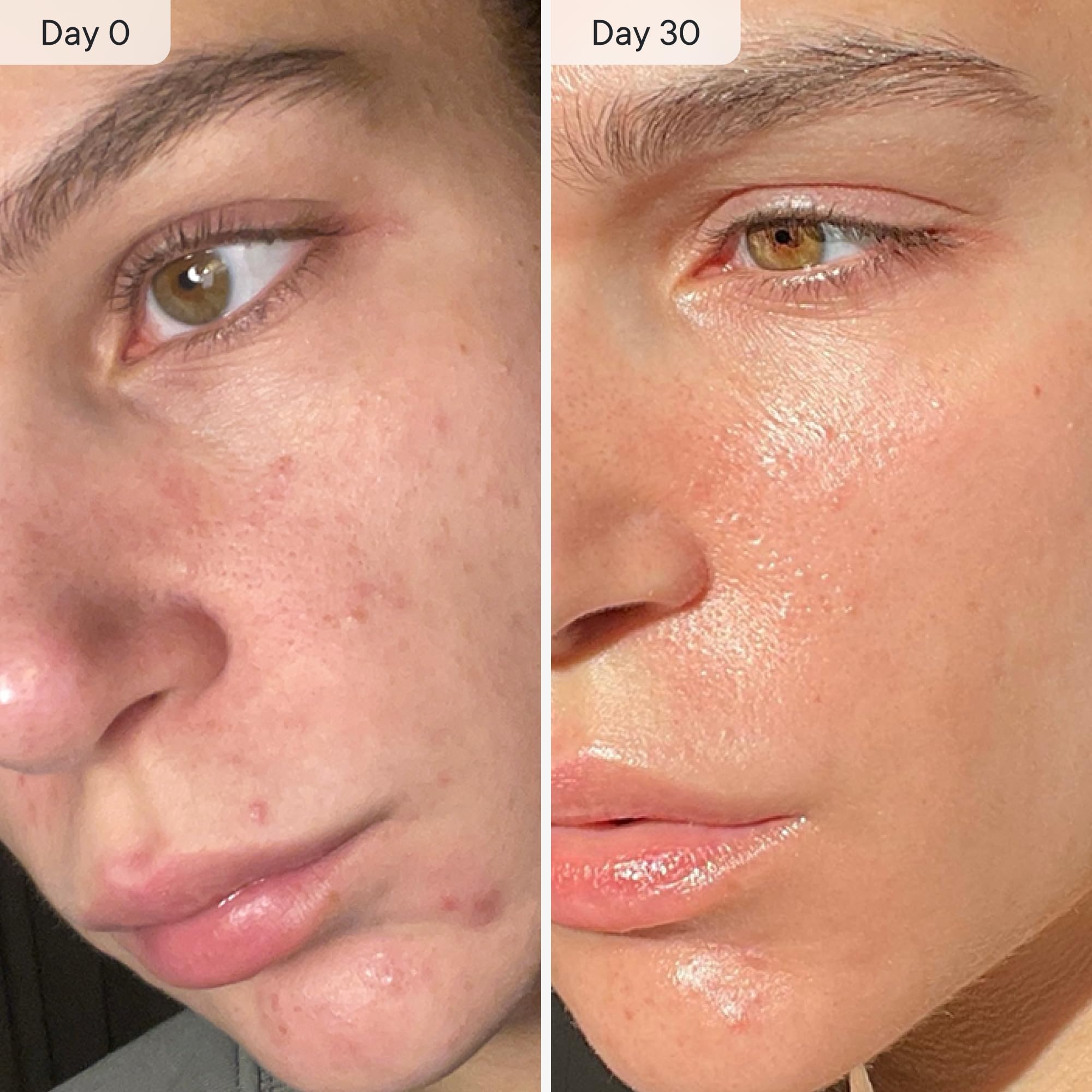 Qure Micro Infusion: experiencia de cuidado de la piel en casa, acabado suave.