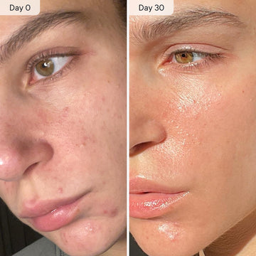 Qure Micro Infusion: experiencia de cuidado de la piel en casa, acabado suave.