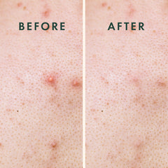 Parche Rael hidrocoloide protege la piel de irritantes.