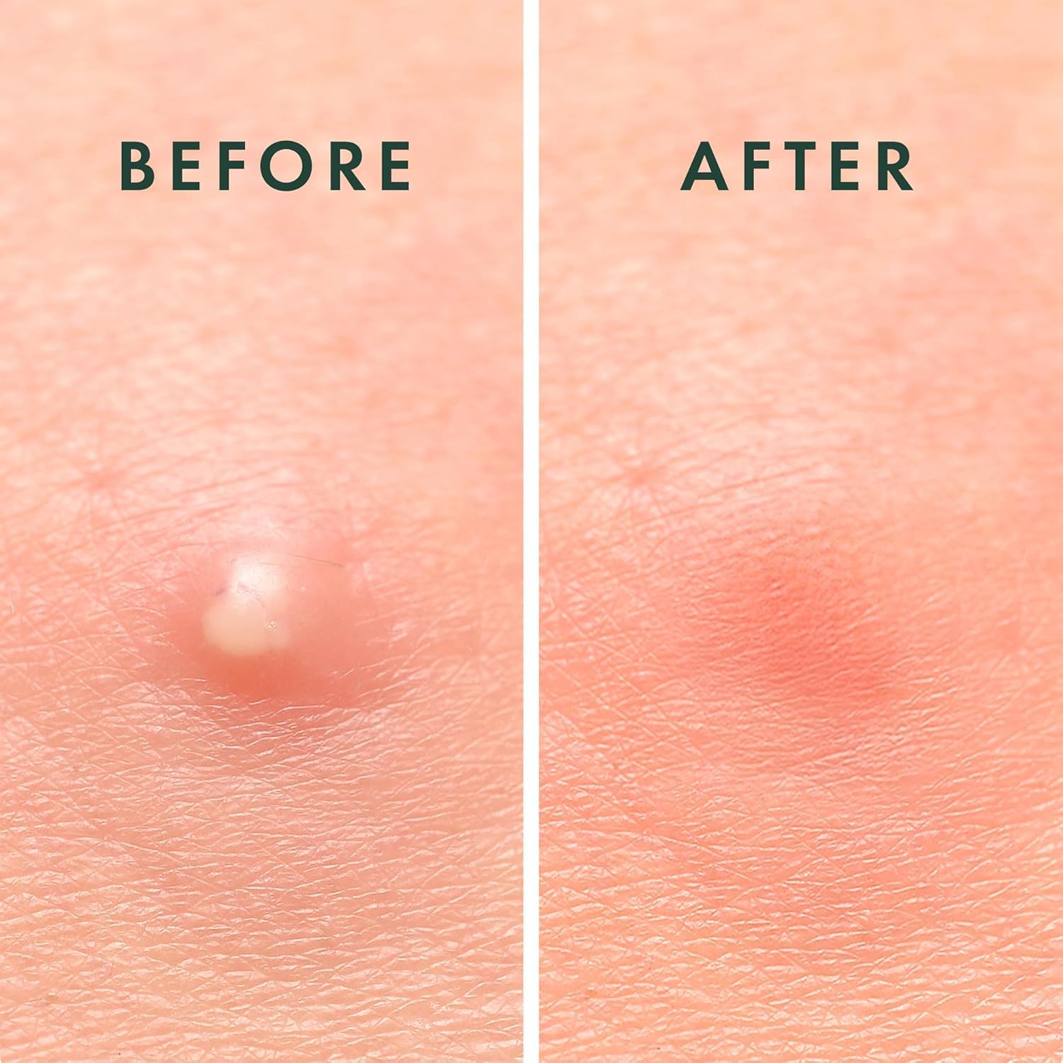 Rael parches de acné cuidado de la piel coreano: complemento a rutinas de cuidado facial.