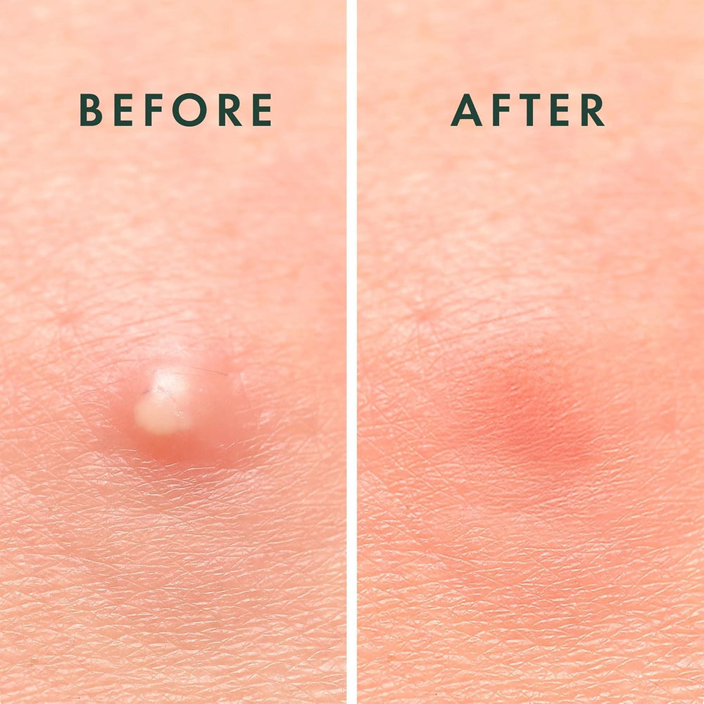 Rael parches de acné cuidado de la piel coreano: complemento a rutinas de cuidado facial.