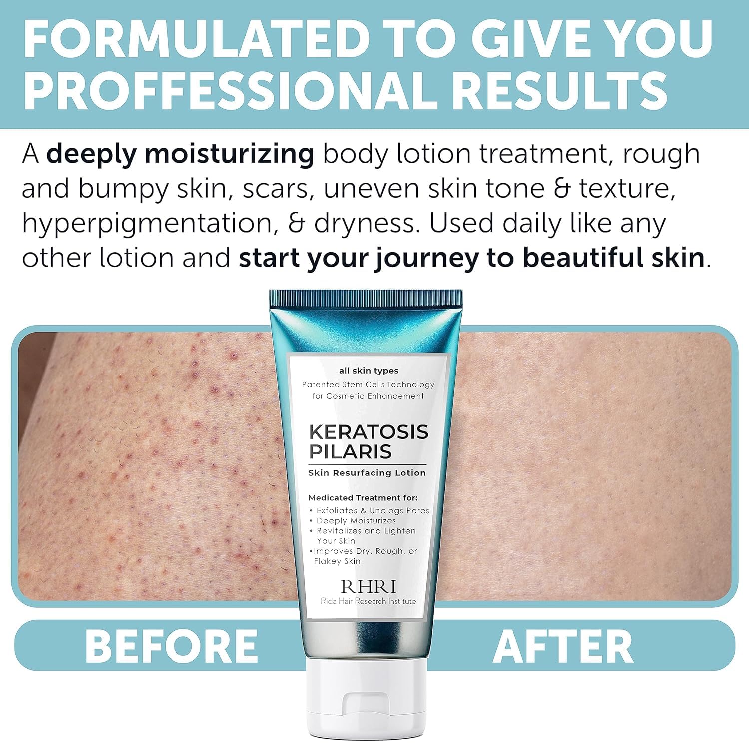 Rida KP Bump Eraser includes glycolic acid for skin renewal