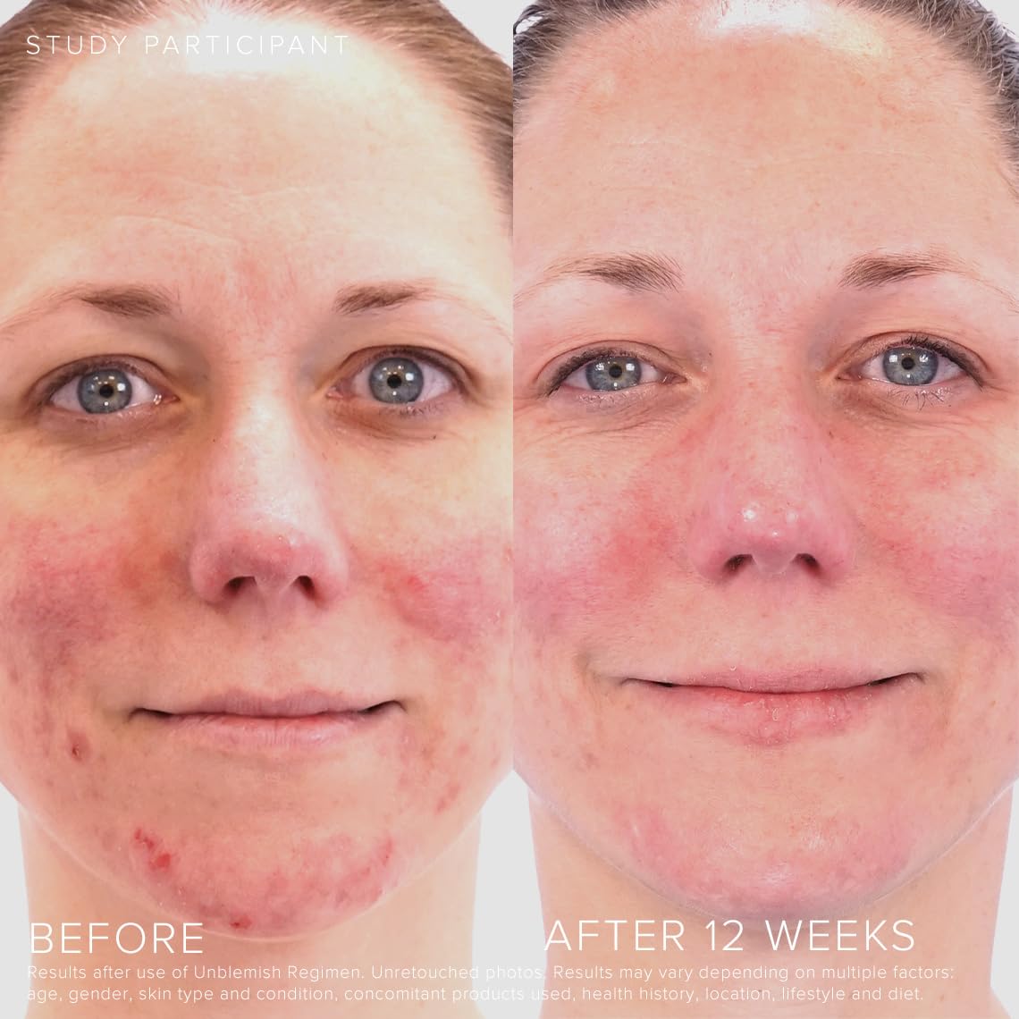 Rodan + Fields Unblemish; peróxido de benzoilo para tratar imperfecciones visibles.
