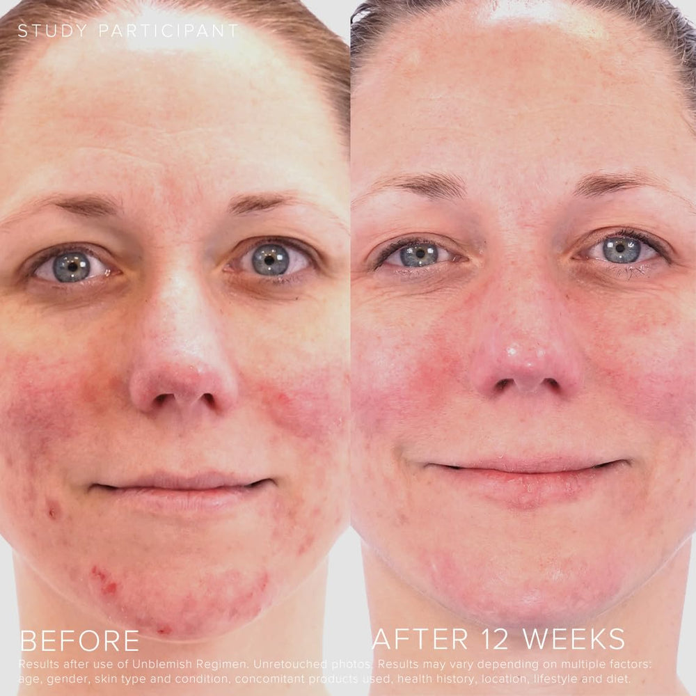 Rodan + Fields Unblemish; peróxido de benzoilo para tratar imperfecciones visibles.