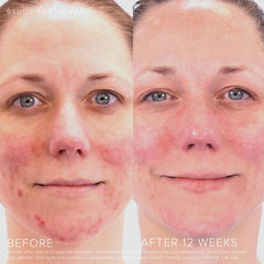 Rodan + Fields Unblemish; peróxido de benzoilo para tratar imperfecciones visibles.