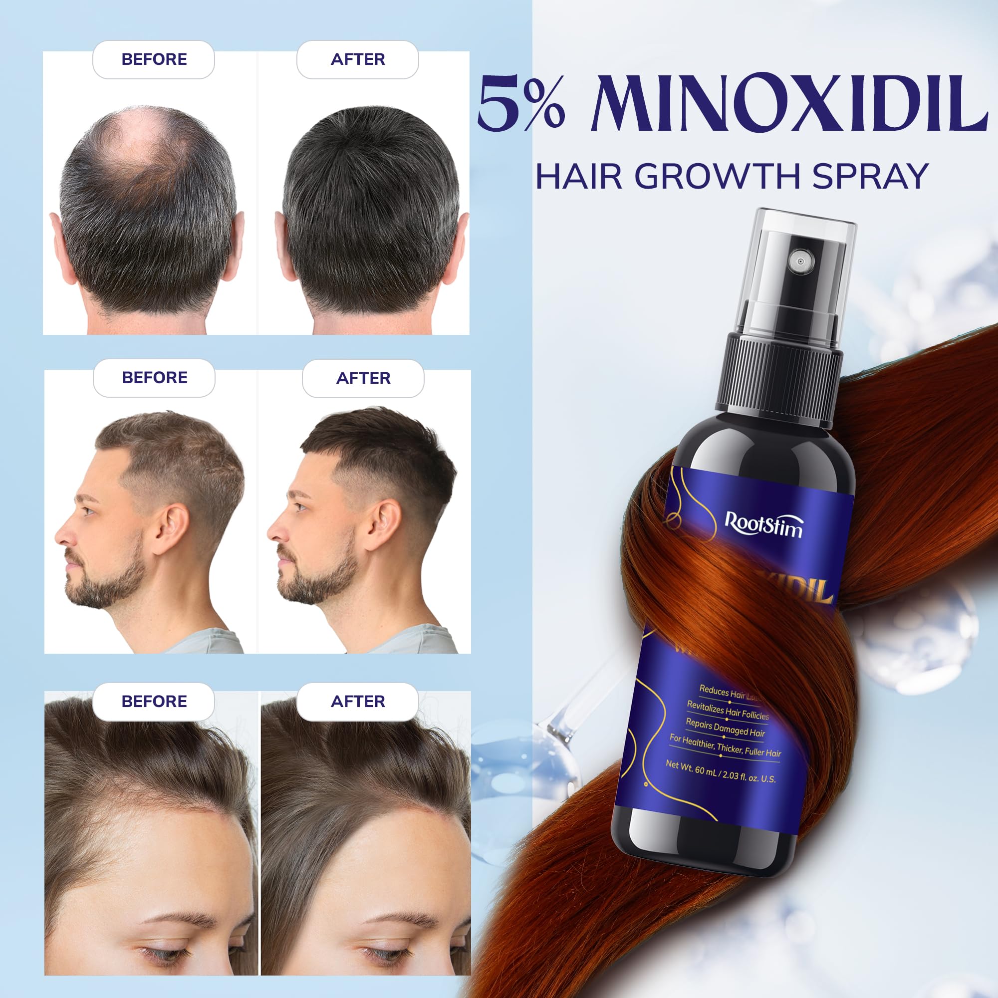 RootStim Minoxidil 5% con romero: frascos del paquete de 3 para uso continuo.