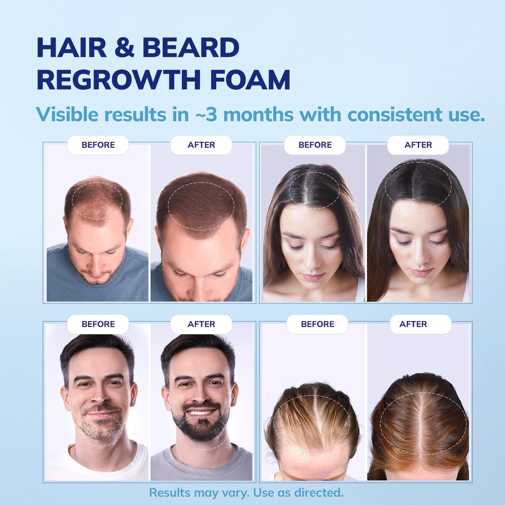 RootStim quick-drying foam on the scalp dries fast with no residue.