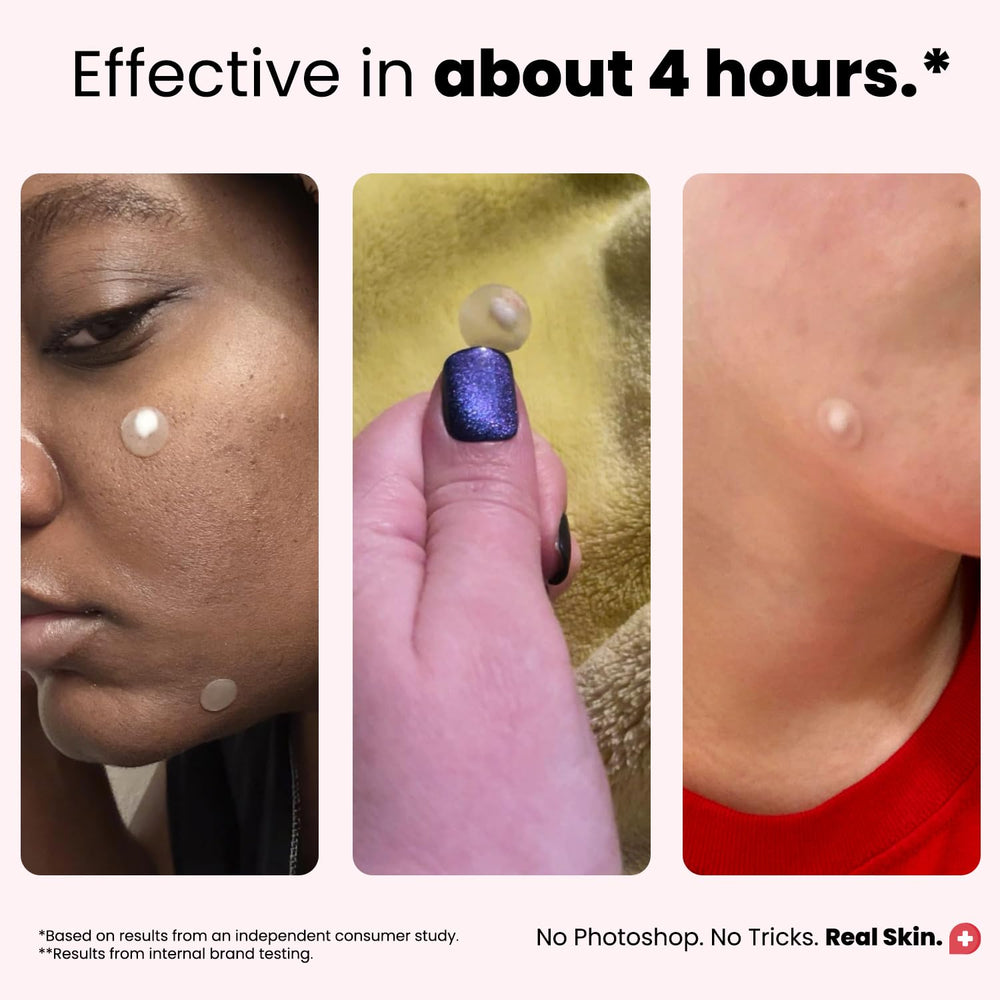 Parches en 4 tallas para ajuste preciso en diferentes brotes.