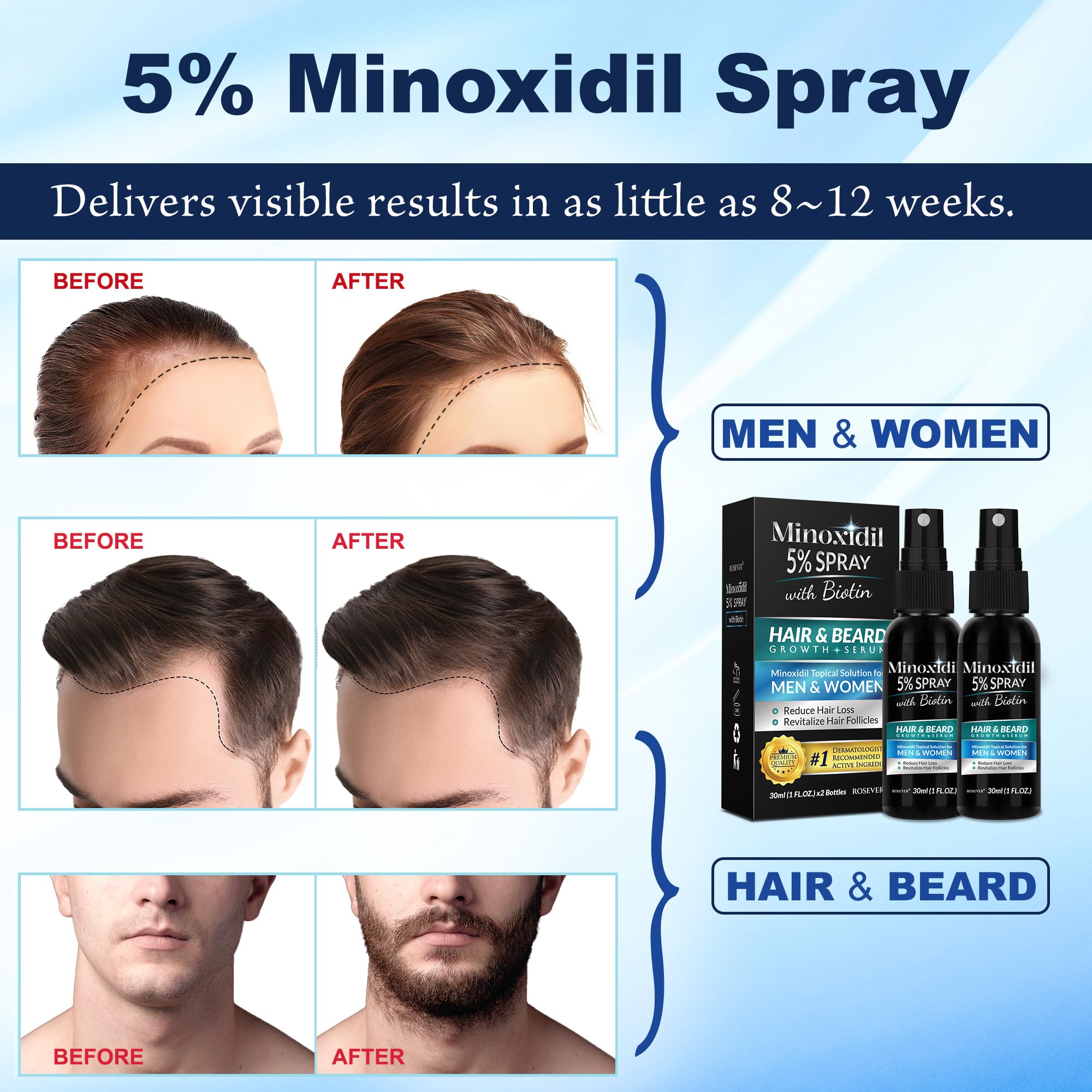 Rosever Minoxidil 5% aplicación en hombre para crecimiento de barba y cabello.