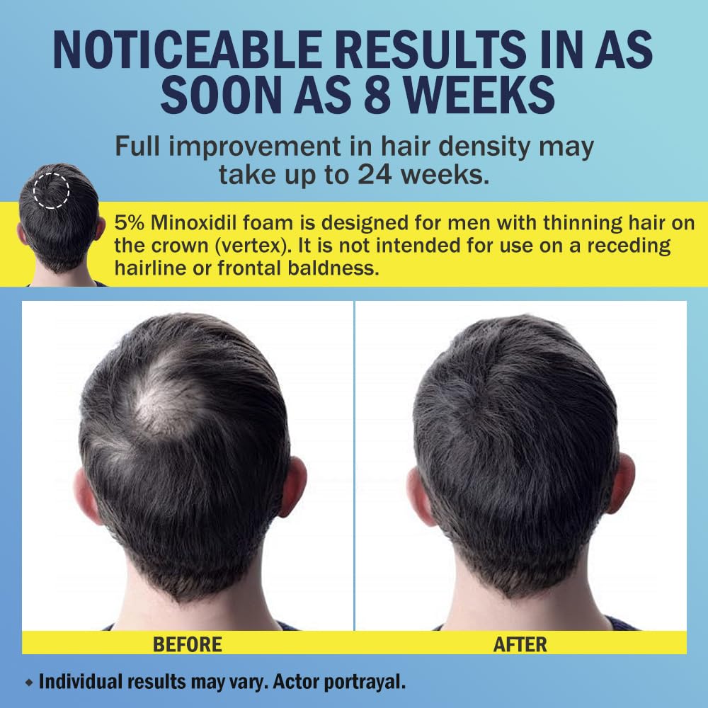 Cabello más grueso y denso con uso regular de Ruahouine Minoxidil.