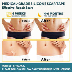 RWT cinta silicona cicatriz, aplicación sencilla en piel