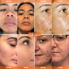 SeoulCeuticals Ácido hialurónico, hidratación profunda para piel suave.