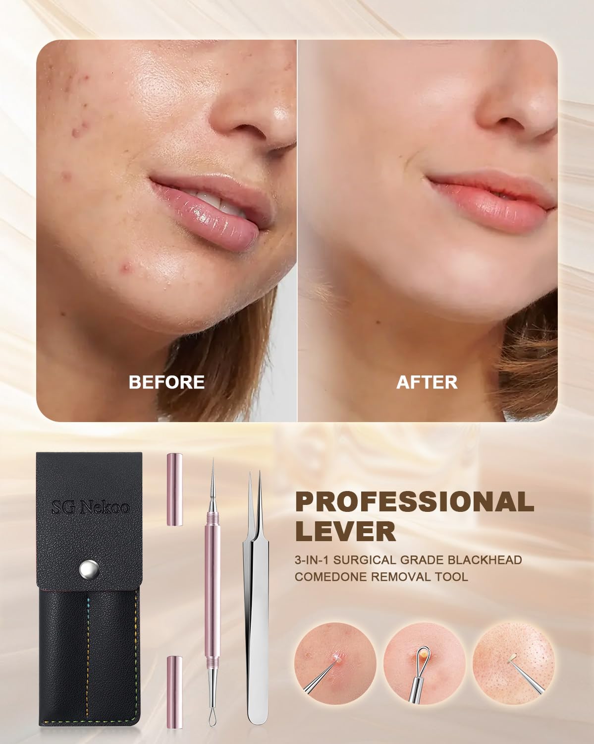 SGNEKOO aguja de titanio de alta durabilidad para uso facial suave.