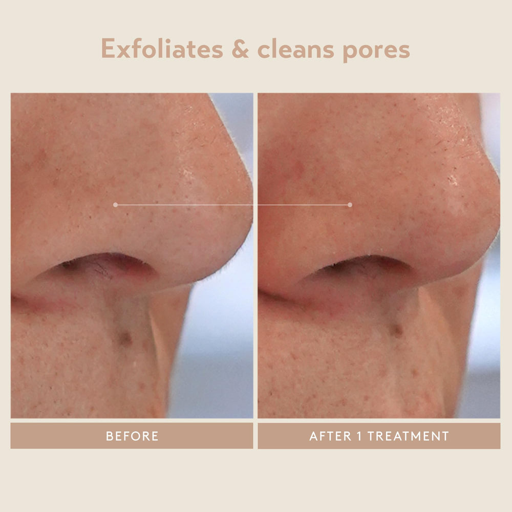 SHANI DARDEN Ácidos exfoliantes: visualización de la mezcla de tres ácidos