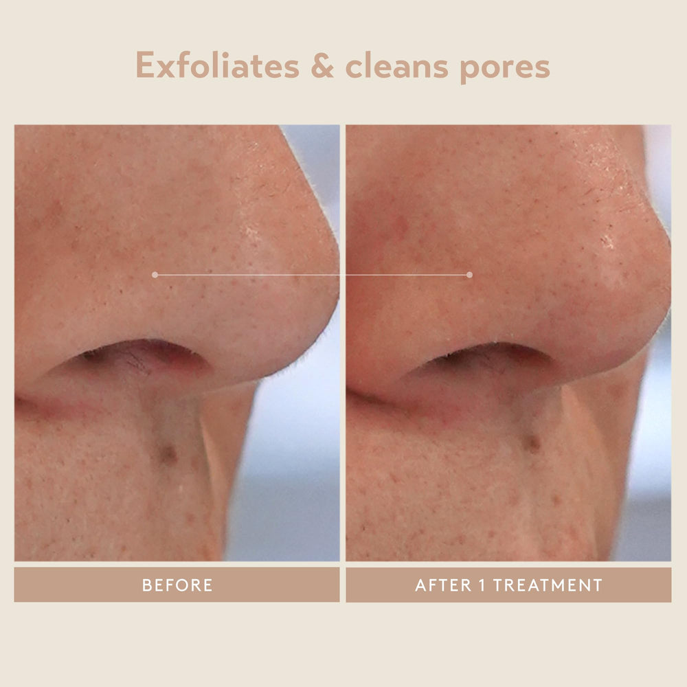 SHANI DARDEN Triple Acid Peel: brillo y radiancia tras el tratamiento suave