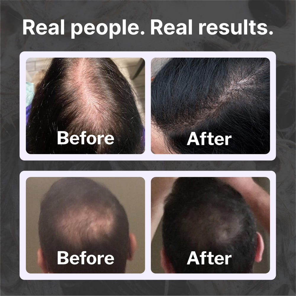 Shapiro MD champú cabello más lleno y grueso a simple vista