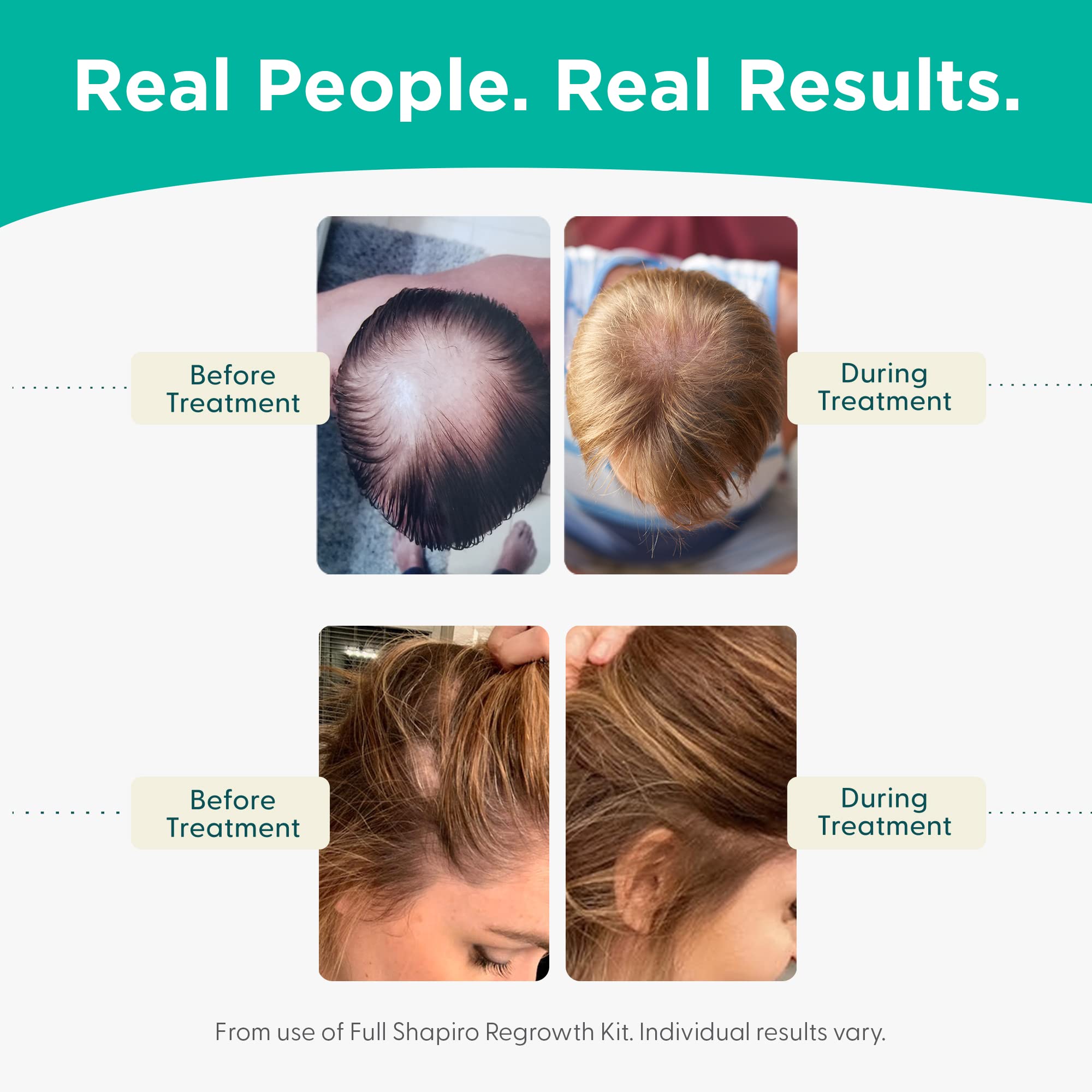 Resultado visible de cabello más grueso con Shapiro MD