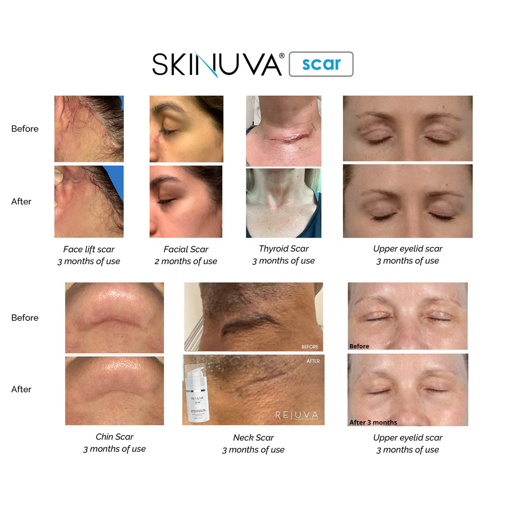Skinuva aplicación dos veces al día, uso práctico para resultados sostenidos.