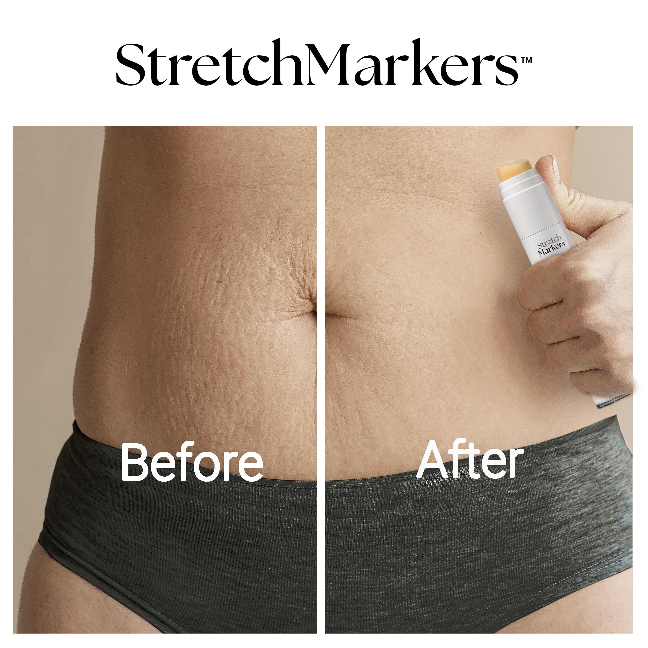 StretchMarkers dermatologicamente recomendado, usa cuidado dirigido para firmeza y luminosidad.