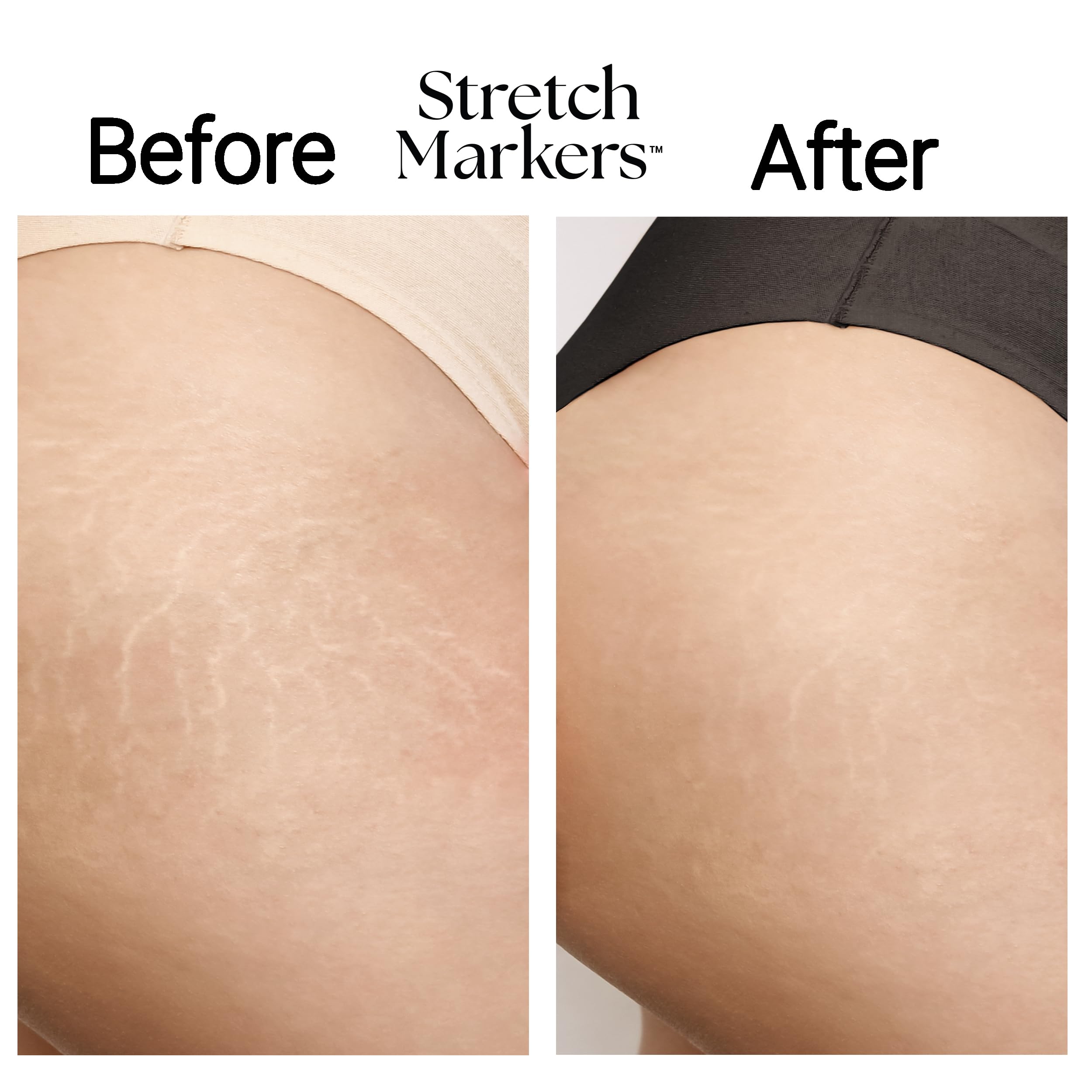 StretchMarkers tecnologia celulas 3d, ayuda a reparar y rejuvenecer la piel.