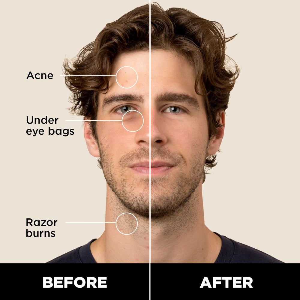 Stryx Concealer Stick being dabbed on the face for natural coverage