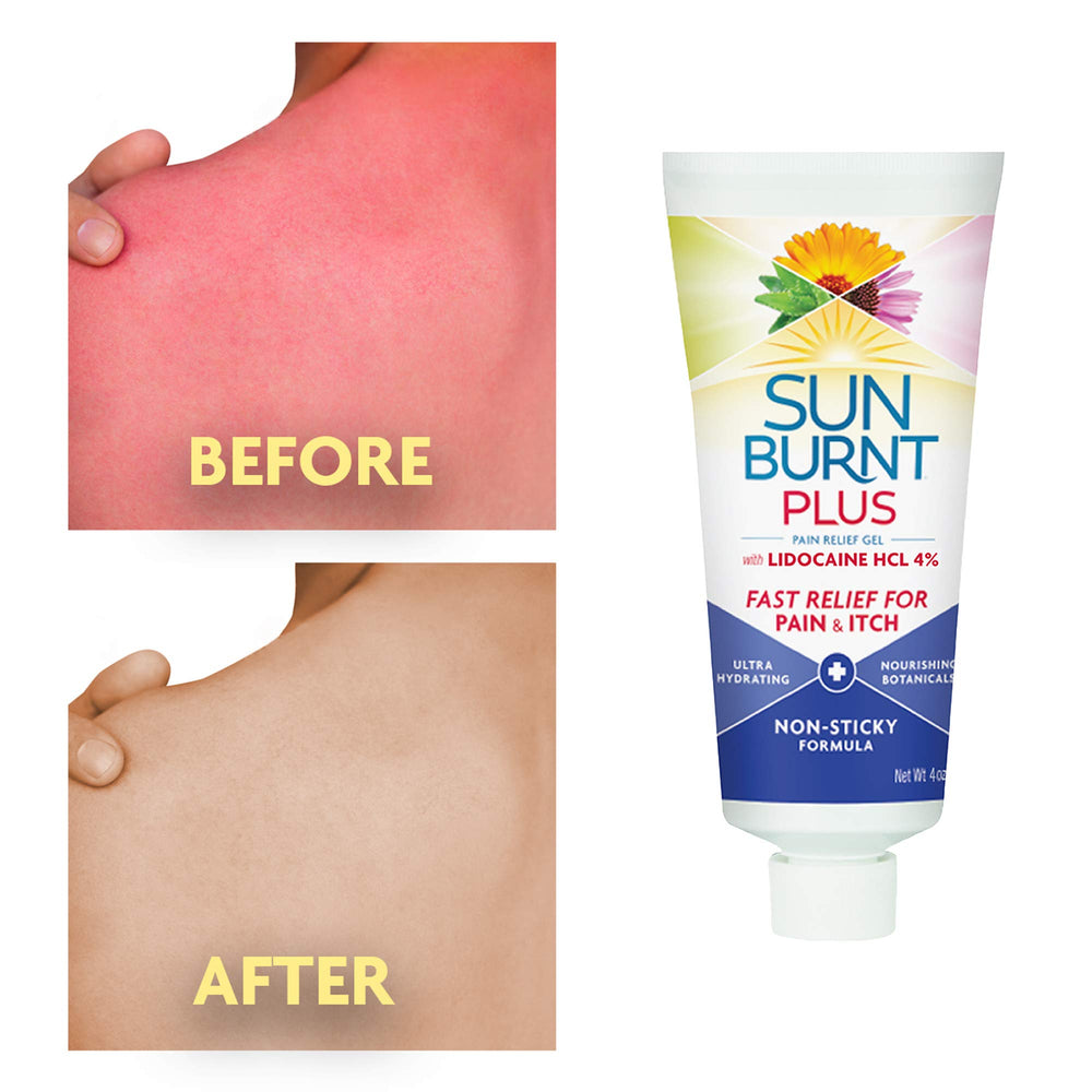 Sunburnt Plus textura-gel-suave, absorción rápida para piel irritada.