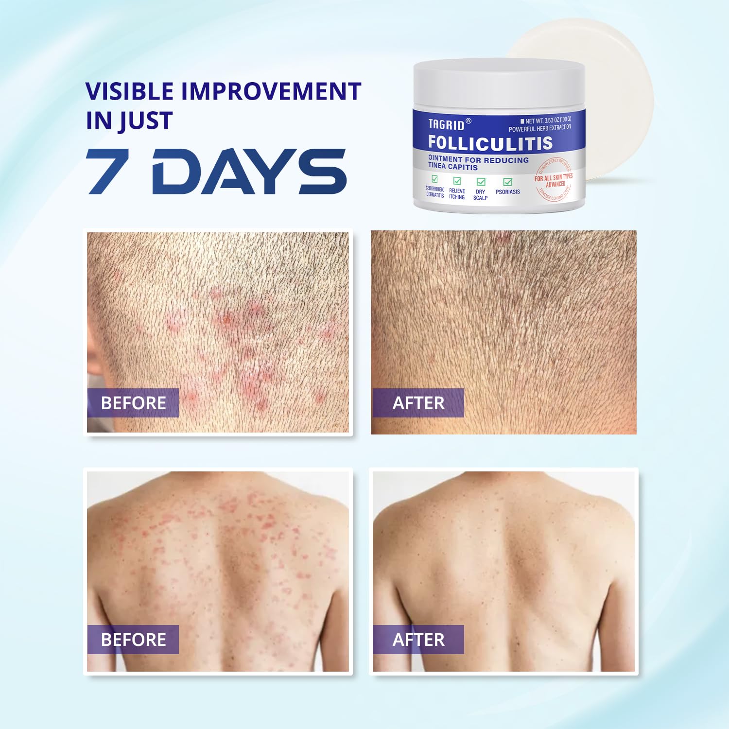 TAGRID Folliculitis Cream jar and packaging highlighting product details.