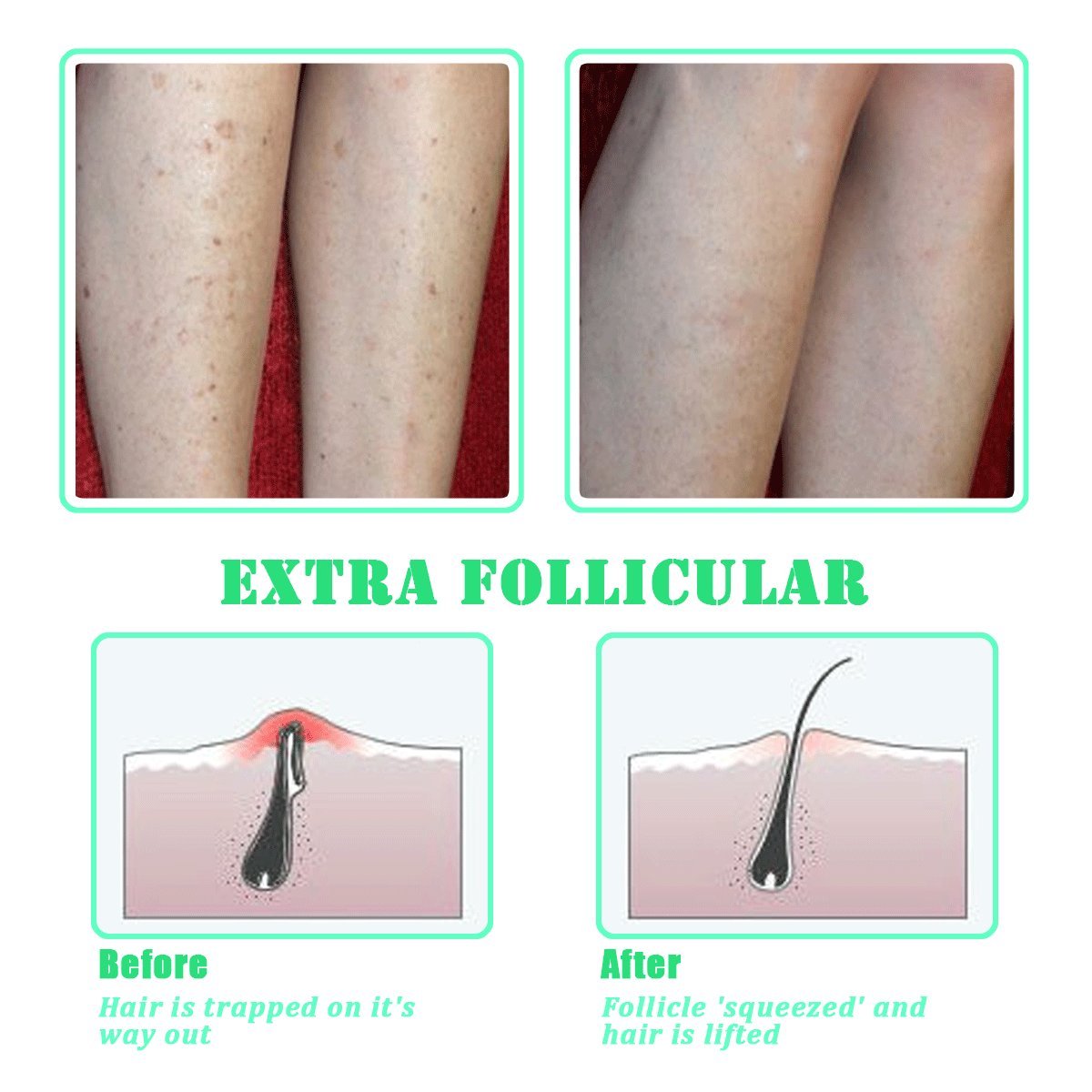 TailaiMei cepillo exfoliante para piernas, axilas y cuello, piel más uniforme y lisa