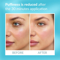 Talika Eye Therapy Patch reducing puffiness around tired eyes