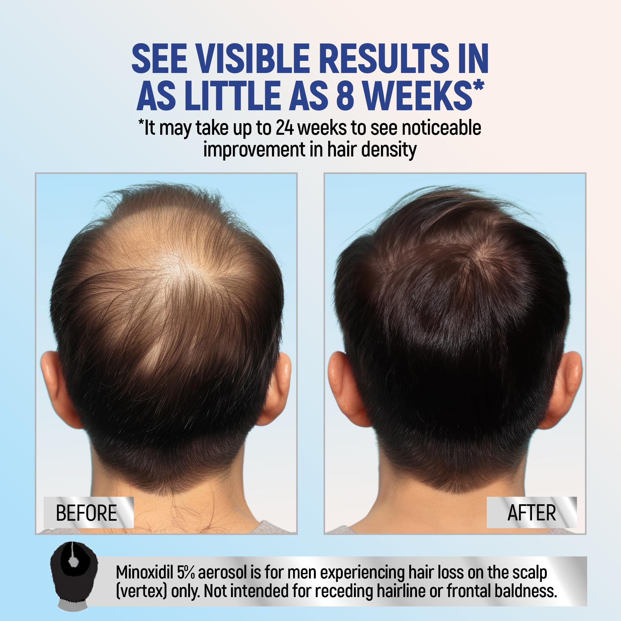 TARO Minoxidil espuma: penetración rápida mejora cobertura capilar.