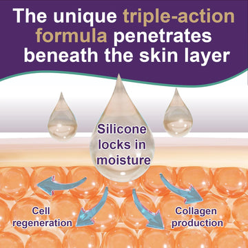 Tearich Gel Silicona para Cicatrices Keloide: favorece la apariencia de cicatrices.