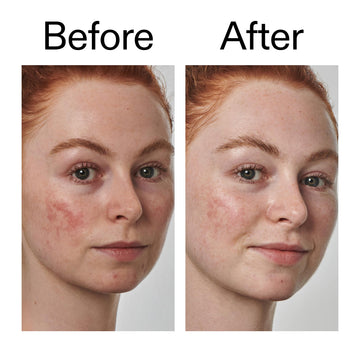The INKEY List acido-azelaico 10% serum compatible con rutinas de cuidado de la piel.