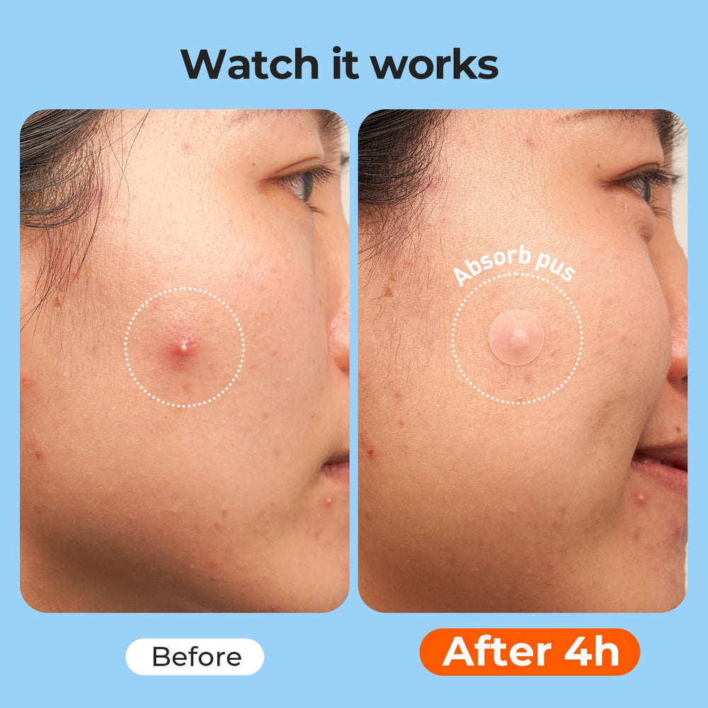 TKTK 609 XL 60x30 mm patch covers larger clusters.