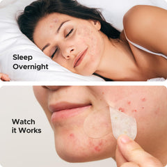 Parches hidrocoloides TKTK 10 mm para zonas concentradas.