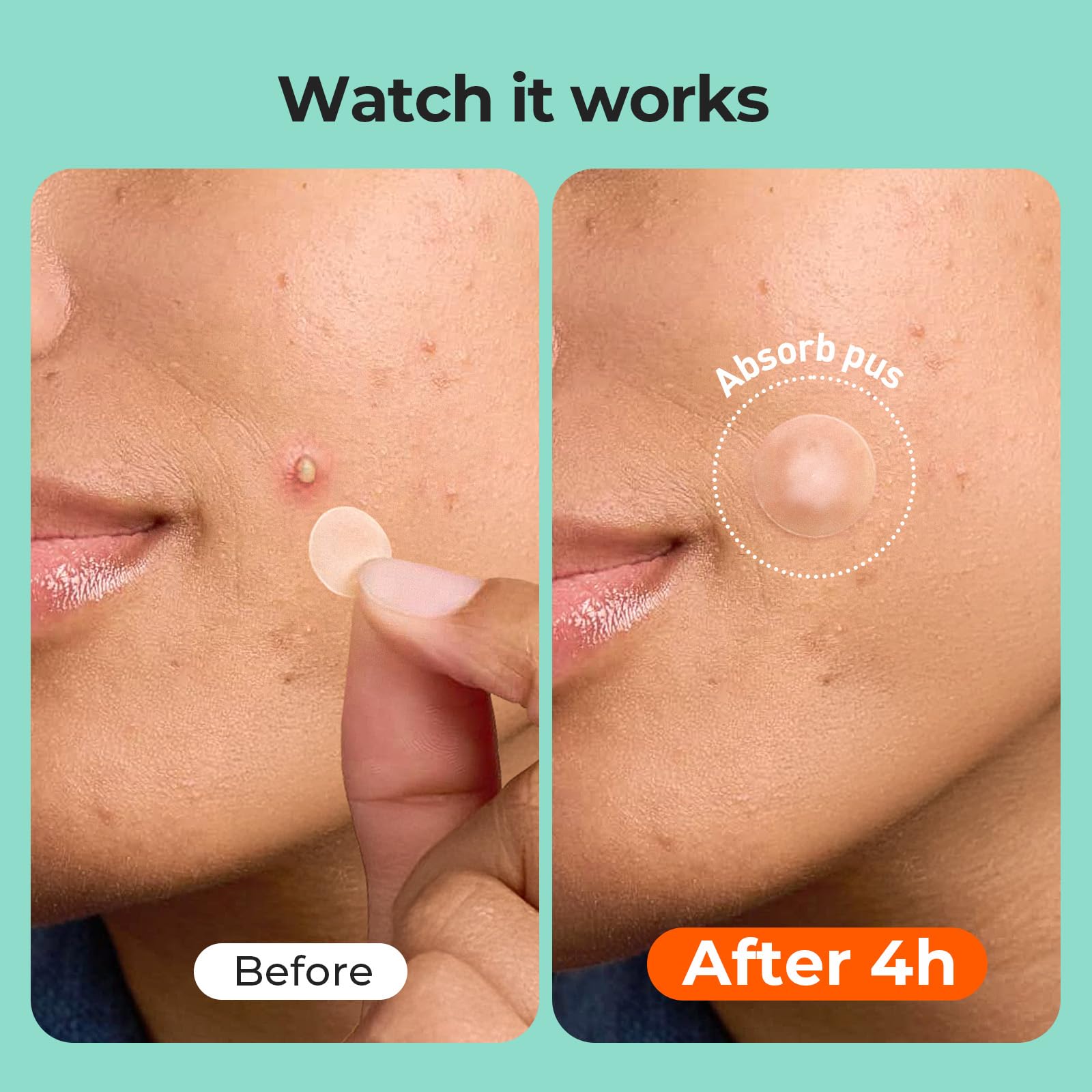 Parche TKTK de 12mm para puntos medianos en la piel