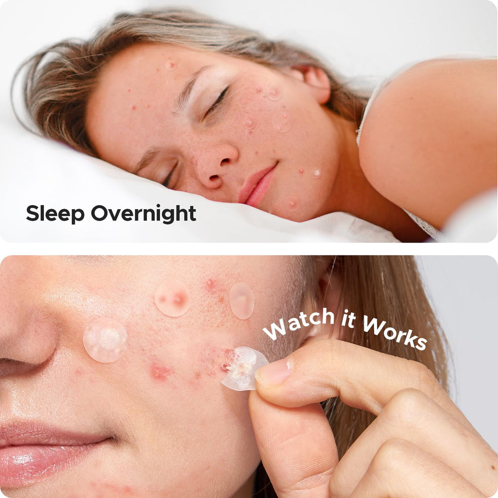 Parche hidrocoloide de 14 mm TKTK para áreas grandes.