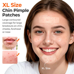 TKTK pore cleaning stripes cleanse pores on forehead and cheeks.