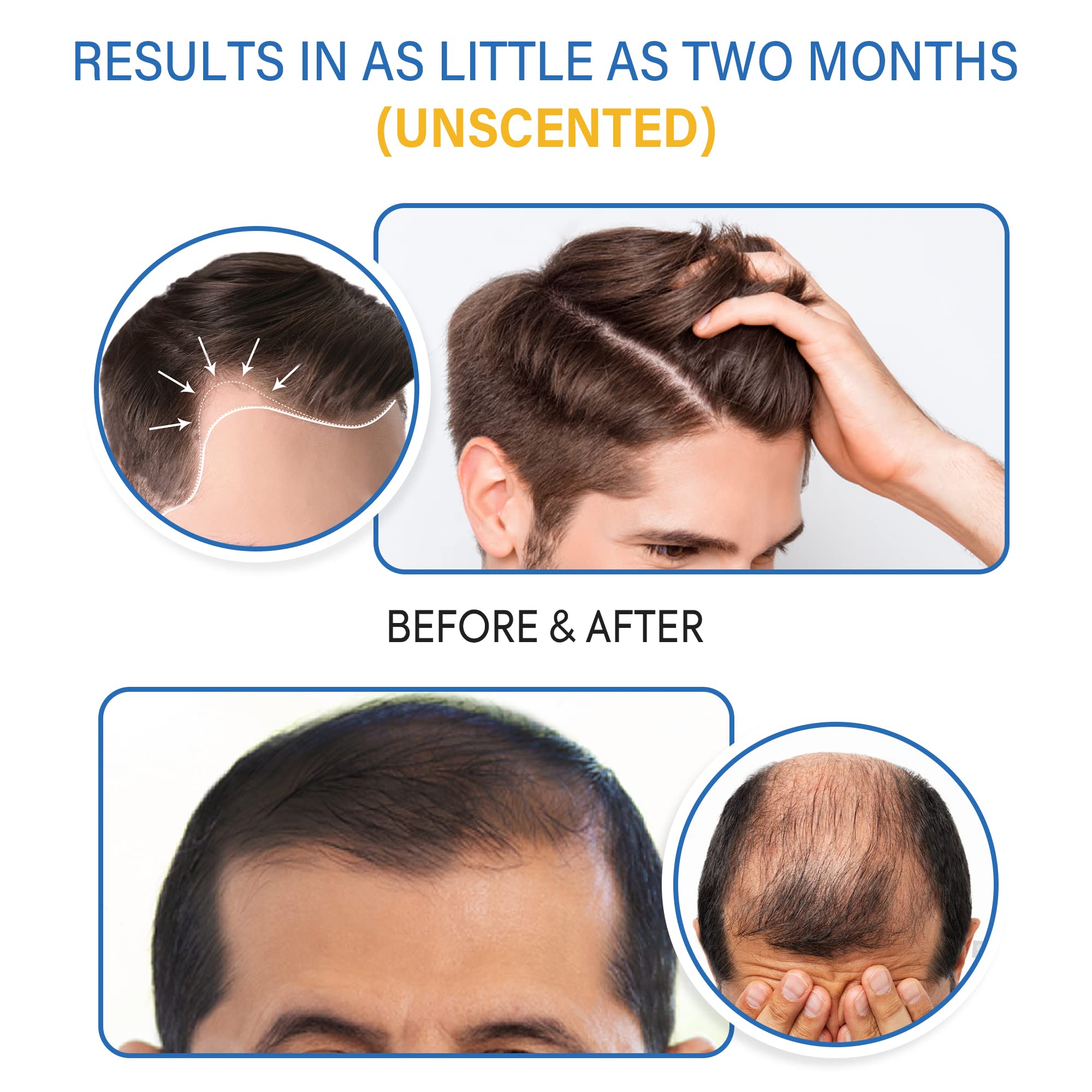 Tomum Minoxidil Foam being applied to clean dry scalp for daily use