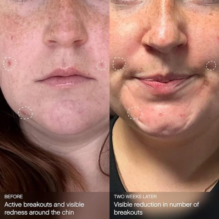 Topicals Clearly Breakout Mask close-up shows smooth texture after application.