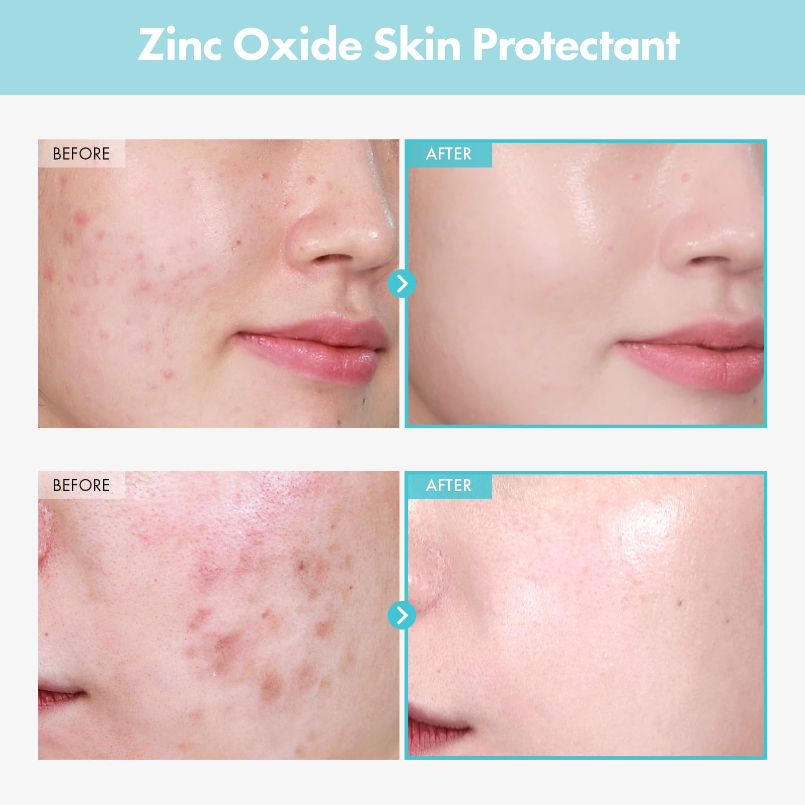 Aplicacion suave Tosowoong Reparacion CICA Clinica para piel sensible y cómoda
