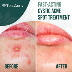 TreeActiv aplicación localizada para acné quístico rostro: uso preciso en áreas sensibles