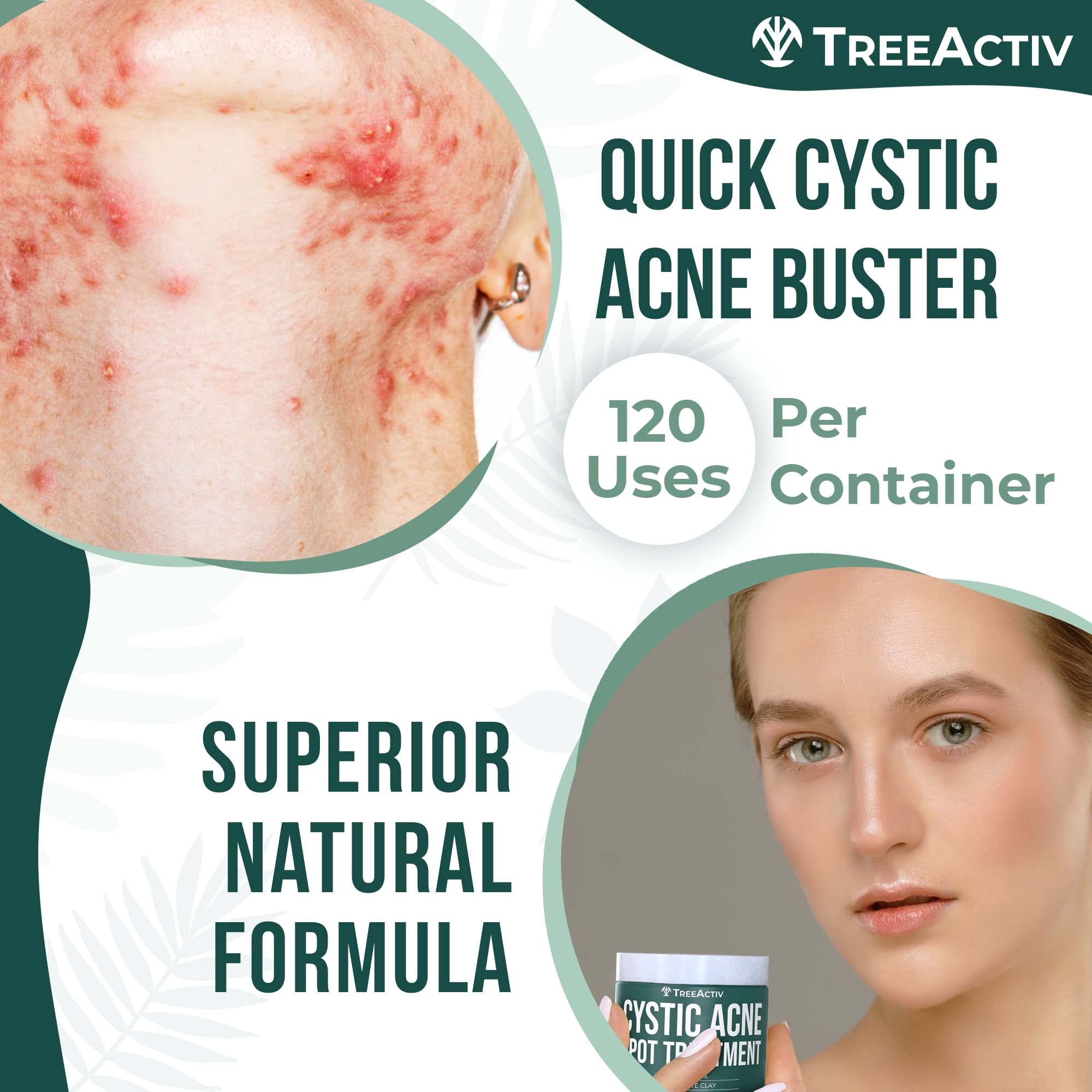 TreeActiv arcilla Bentonita Azufre Arbol de Te: ingredientes naturales