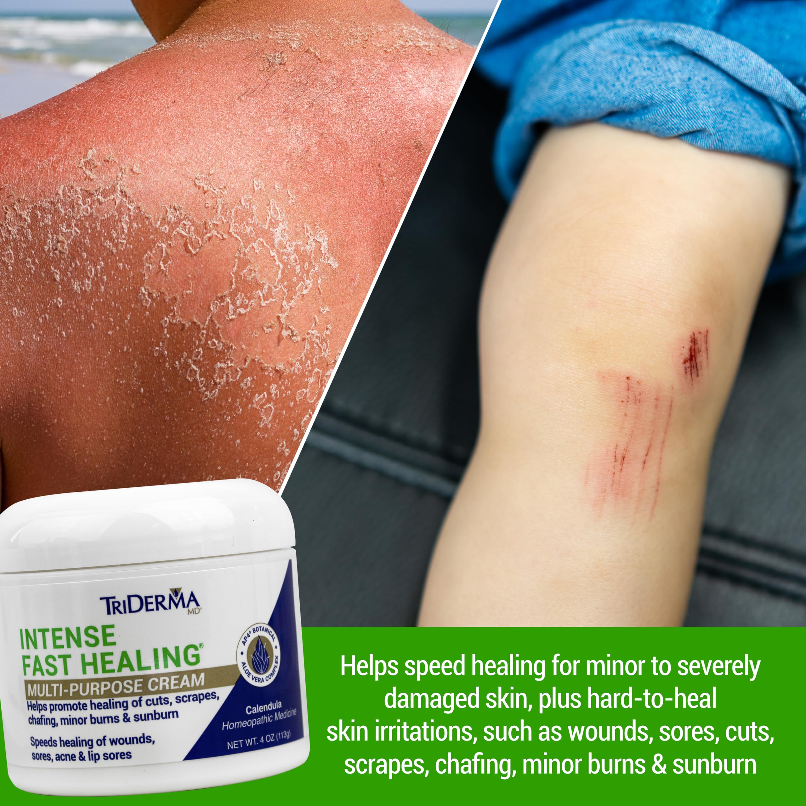 Aplicación de TriDerma en manos para irritaciones y sequedad.