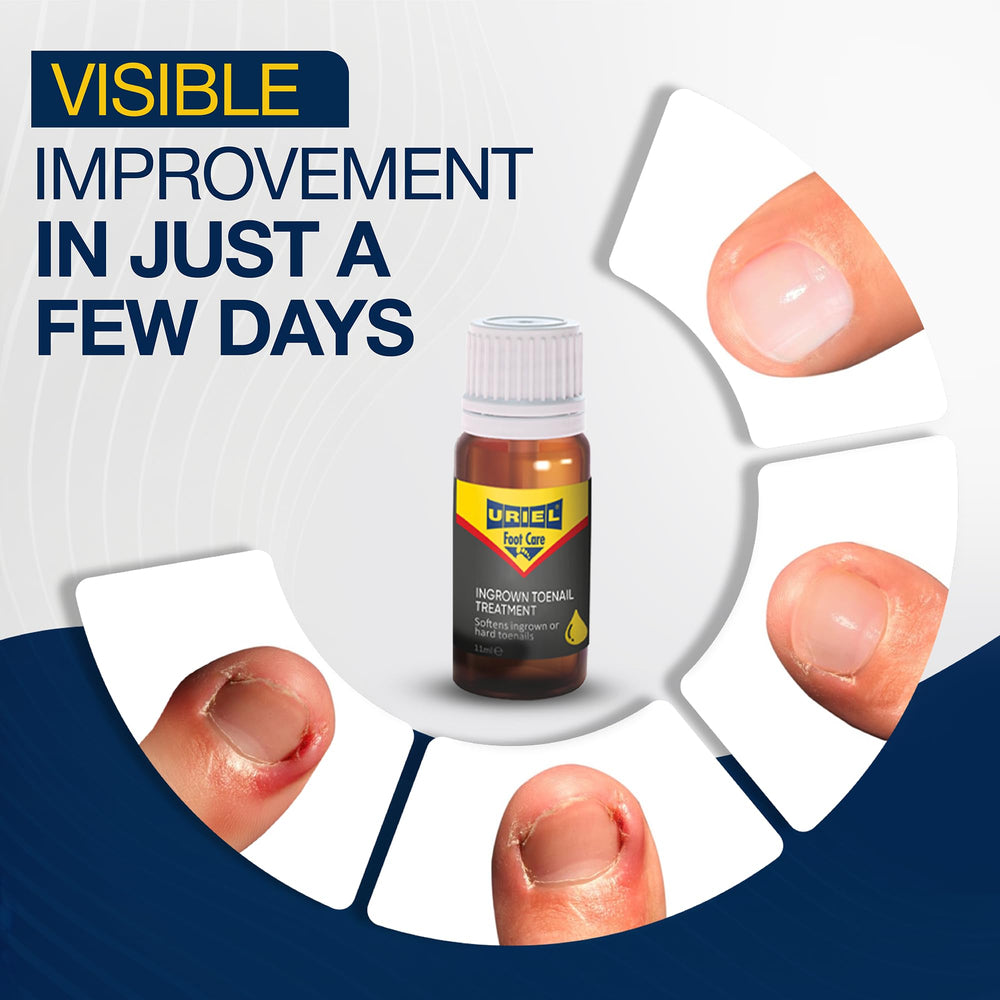 URIEL Kit Retrait Ongle Incarné: ensemble pratique pour une prise en charge à domicile.