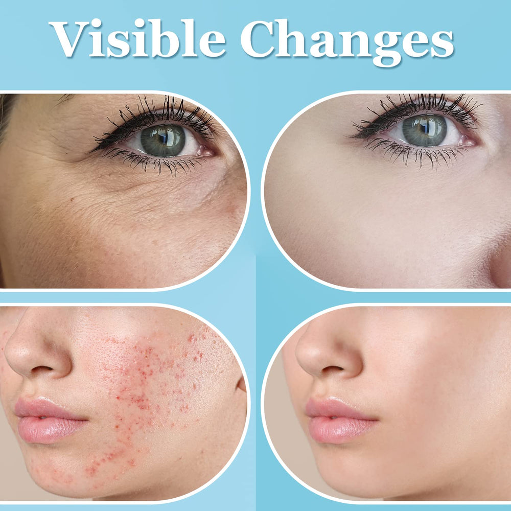 UUPAS tubo en forma de Y para tratamiento facial seguro y cómodo